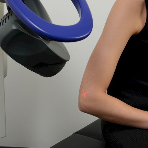 A person in a black top undergoing a medical procedure with a machine, positioned near their arm with a small red mark visible.