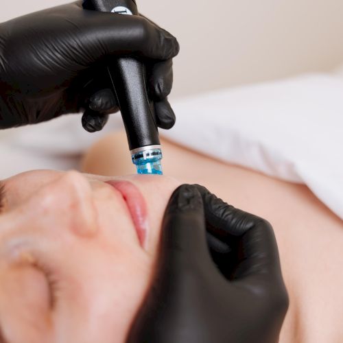 A cosmetic procedure is being performed on a person&rsquo;s face with a suction device and a precision tool, under medical gloves and sterile setup.